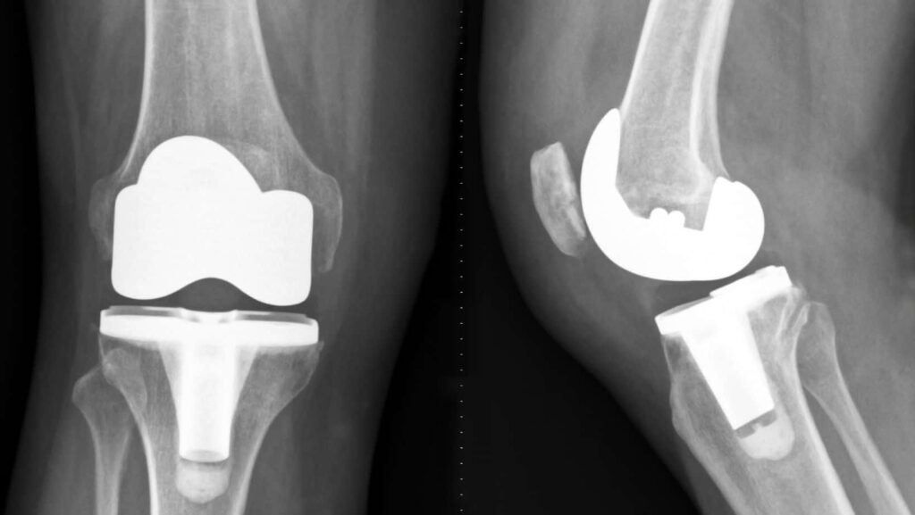 Top 5 Post-Knee Replacement Surgery Errors for a Smooth Recovery and Minimized Complications