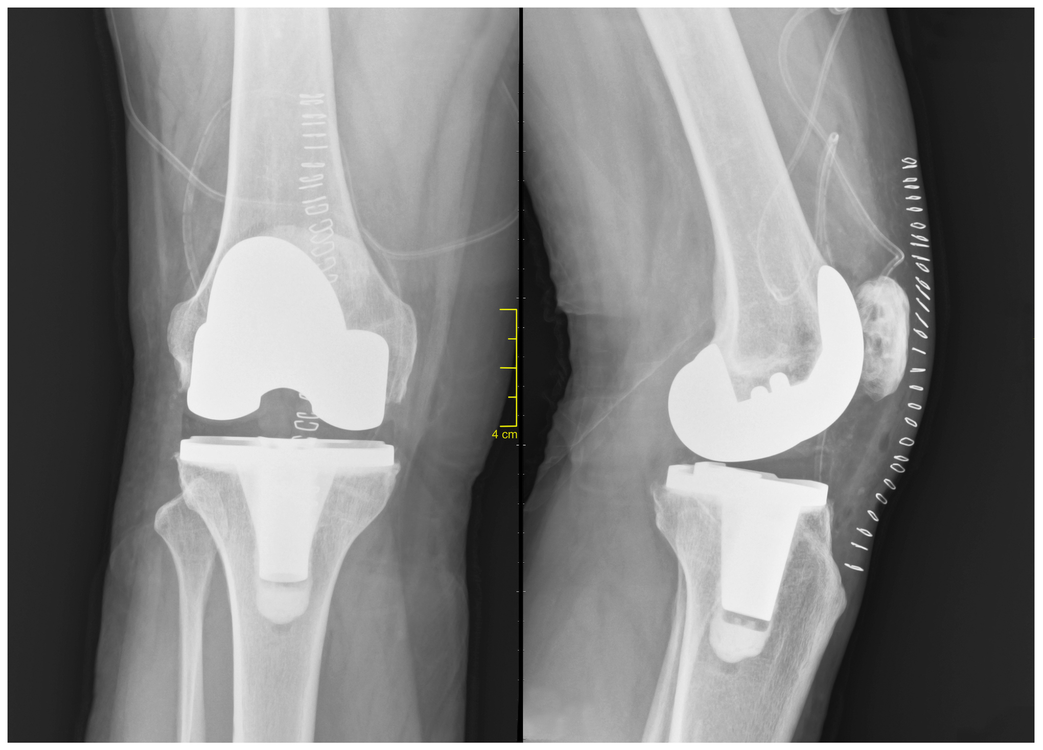 Top 5 Post-Knee Replacement Surgery Errors for a Smooth Recovery and Minimized Complications