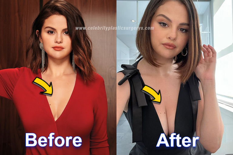 Selena Gomez  Breast Implants 
