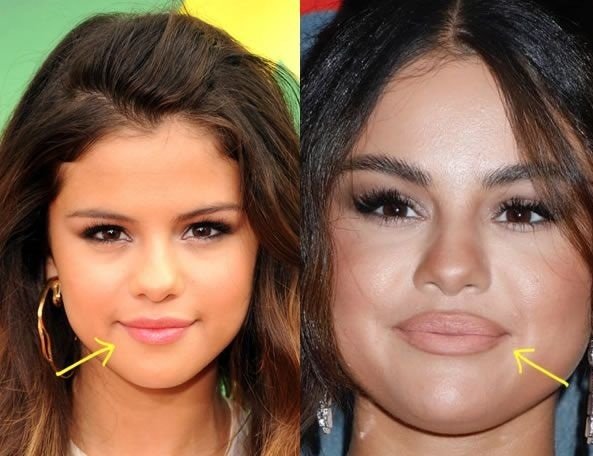 Selena Gomez  Nose job1`