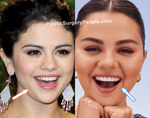 Selena Gomez  Teeth Sugery